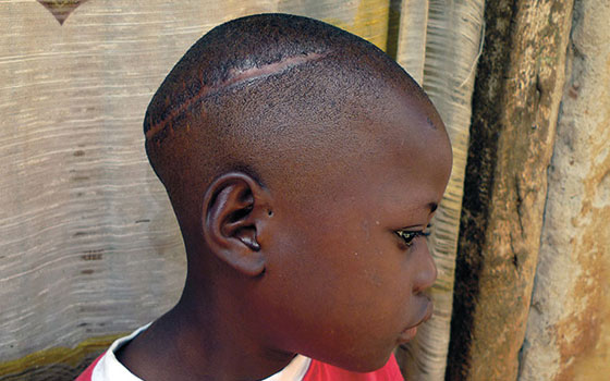 Child sacrifice survivor Allan showing scar on head